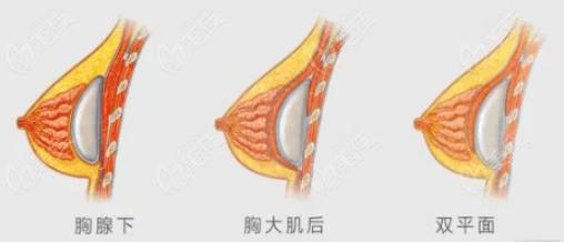 杭州艺星假体隆胸采用双平面技术