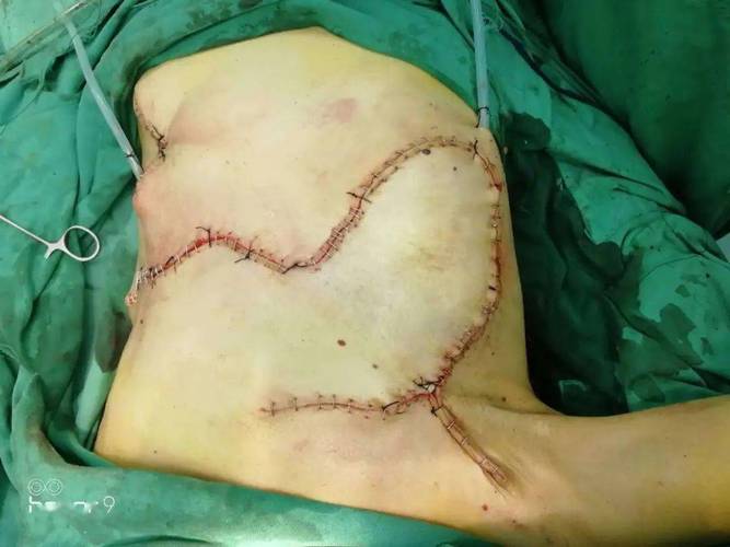 局部皮瓣转移手术对患者创伤较小