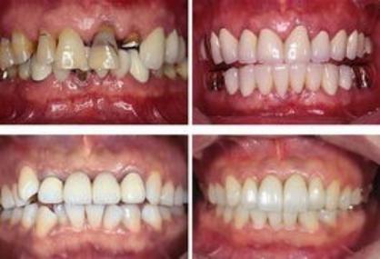 牙齿的美观能决定笑容的质量如今烤瓷牙修复牙齿的效果越来越到到