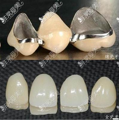 重庆烤瓷牙全瓷牙冠价格大约多少钱一颗费用价位汇总公开