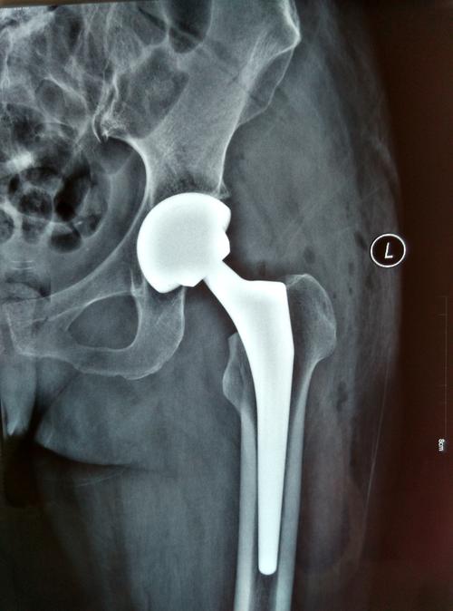 股骨颈骨折行人工全髋关节置换术