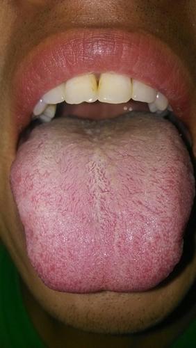 这是得了艾滋病的舌头吗