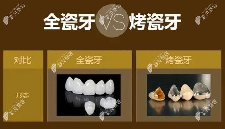 北京全瓷烤瓷牙价格表来看北京一颗全瓷牙比烤瓷牙贵多少