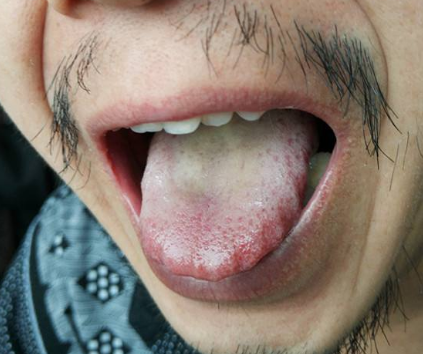 胃炎的症状舌头图片