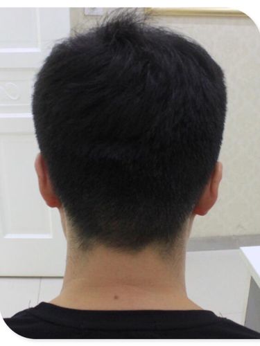 种植头发取的是后脑勺的毛囊资源现在发际线恢复了圈子