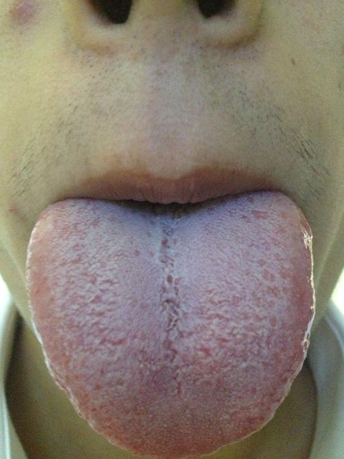 请中医帮我看一下我的舌苔.