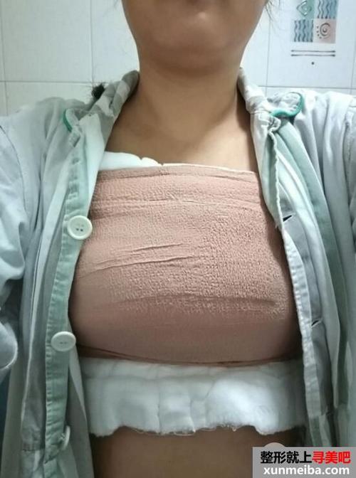 缩胸整形手术前后对比图分享