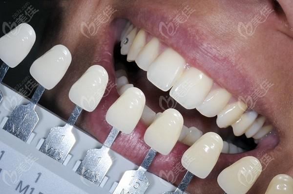 做超薄全瓷贴面牙一般要多少钱一颗2021年全新牙齿贴片价格公布