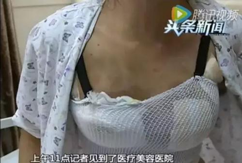 深圳女子花6万元去隆胸结果整个胸都腐烂了