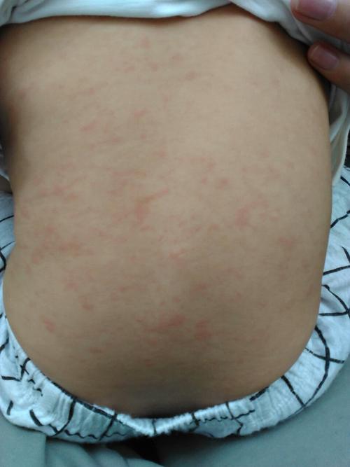 5度这两天退烧后前胸和后背起红色皮疹请问这是幼儿急疹吗