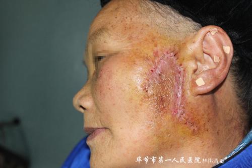皮肤科为一76岁左面部巨大鳞状细胞癌患者手术