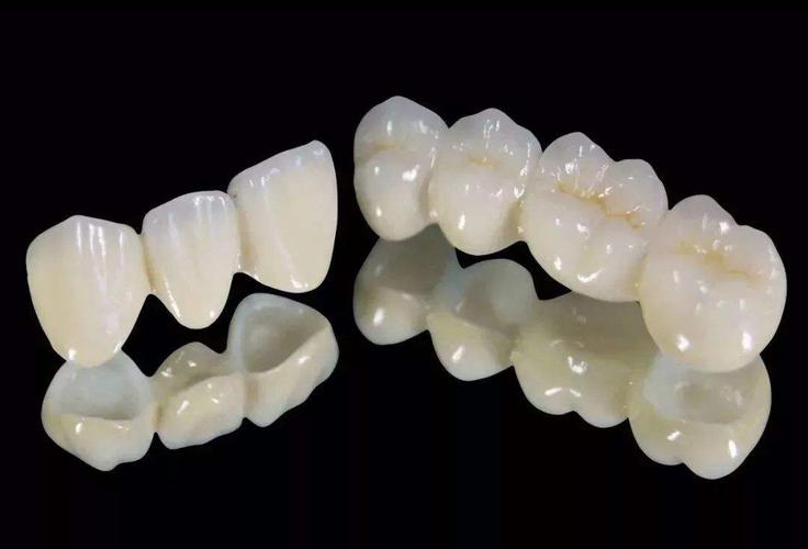 也可分为氧化铝全瓷牙铸造全瓷牙以及二氧化锆全瓷牙二氧化皓全瓷牙