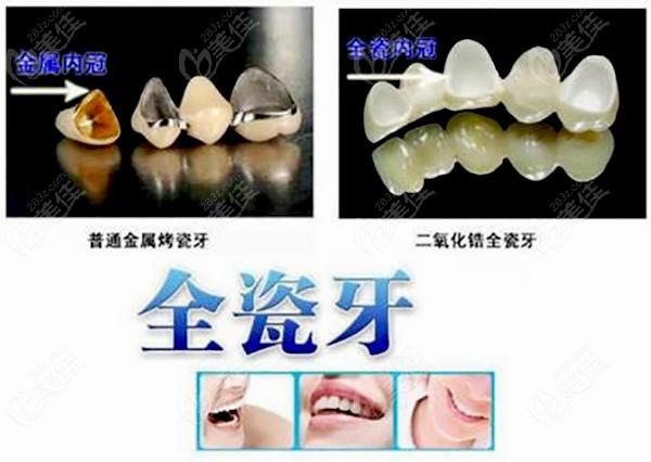 郑州二七区口腔医院镶牙多少钱做全瓷牙是比烤瓷牙贵不少