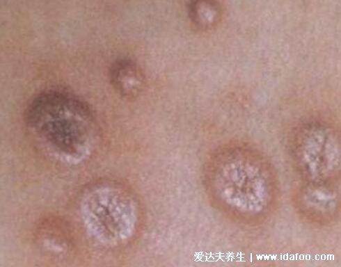 常见男科性疾病图片梅毒生殖器疱疹尖锐湿疣五种性病症状图