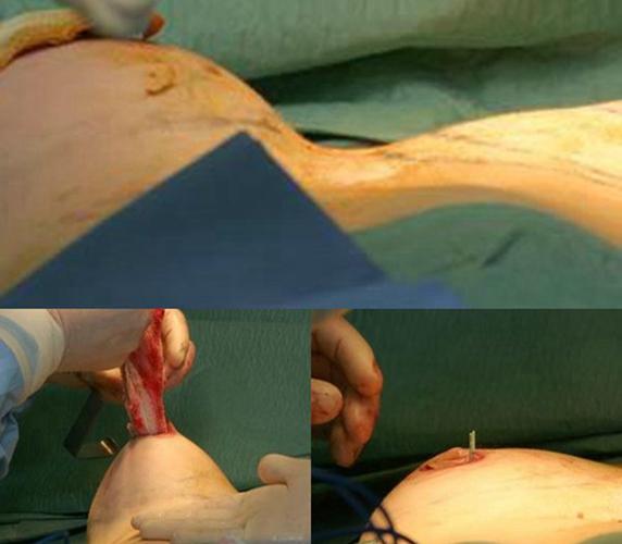 实拍隆胸手术过程图片