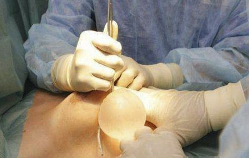在一些不正规的黑心诊所进行隆胸手术由于医生的专业水平假体材料