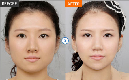 瘦脸手术前后对比图