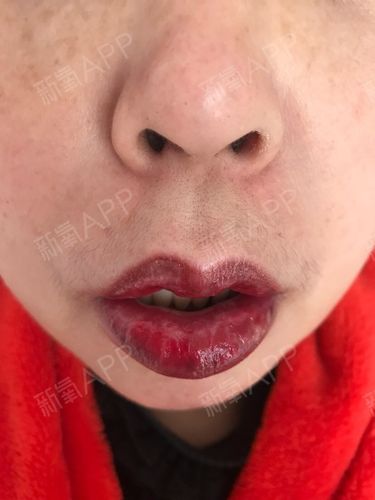 今天是纹完唇的第四天嘴唇肿的有点更厉害了唇色也很深很乌