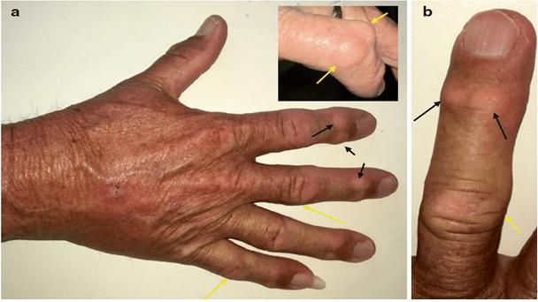 手骨关节炎的两种不同结节如何区分