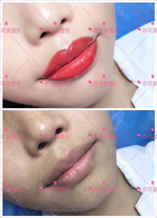 天津亦可美客医疗美容半永久纹唇怎么样恢复过程效果如何氧气6dkpz
