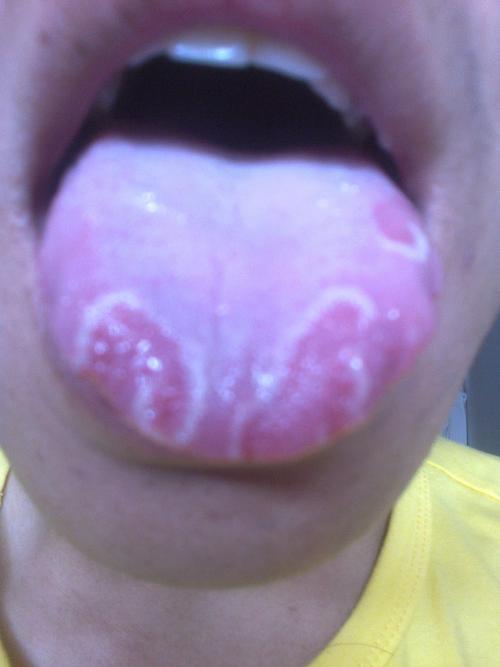 我的舌头怎么回事