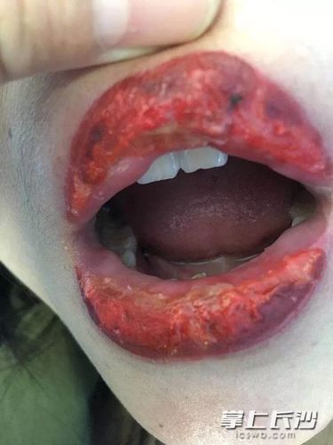 长沙29岁女子美容做樱桃唇反感染变水疱唇