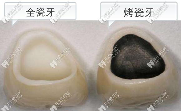 广州牙科医院镶牙多少钱这有广州口腔医院全烤瓷牙价格表