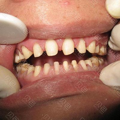 戴全瓷牙套的危害有哪些听说全瓷牙套里的牙会烂是真的