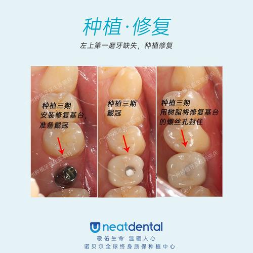 最后一点关于医生的种植牙案例数量和效果这也是患者了解种植牙效果