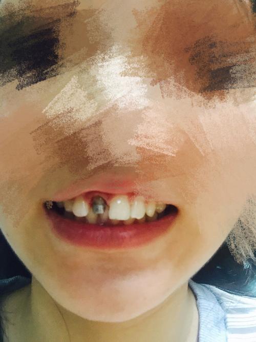 以前把门牙摔断了后面就去打的金属桩安的烤瓷牙后面牙齿变色了上