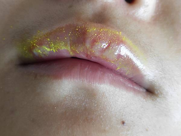 上嘴唇起水泡还有点肿怎么办黄色的是药粉