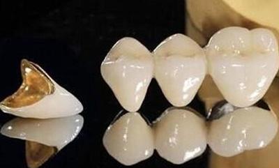 烤瓷牙修复适用于哪些牙齿问题