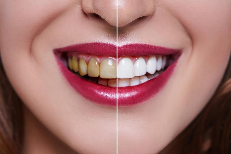 牙齿不美观使用瓷贴面真的有优势吗义齿
