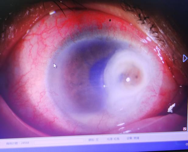 角膜炎发展到角膜穿孔前房积脓是什么样子