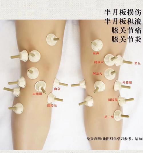 赵倩妈妈的膝盖积液问题的艾灸方案