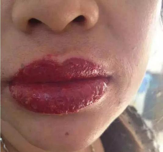 唇部厌氧菌感染案例纹绣后期修复问题