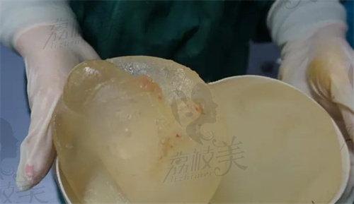 吴江山医生做隆胸修复可以做假体取出