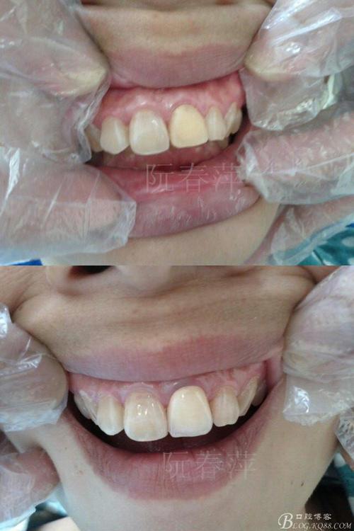 一例门牙外伤冠折烤瓷修复病例