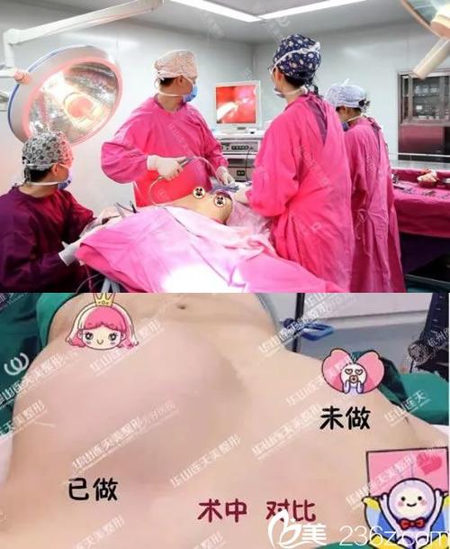 杭州连天美程琳隆胸手术过程