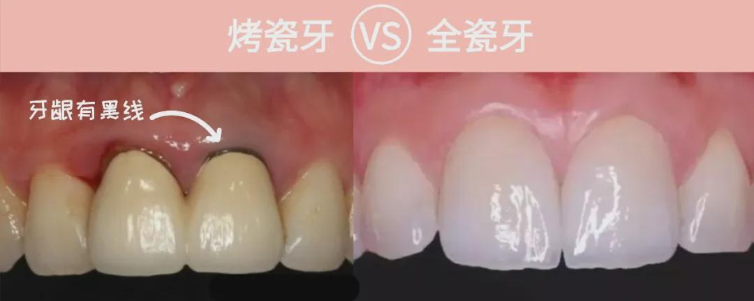 烤瓷牙使用年限久或不注意口腔卫生牙龈容易长出黑线全瓷内不含金属