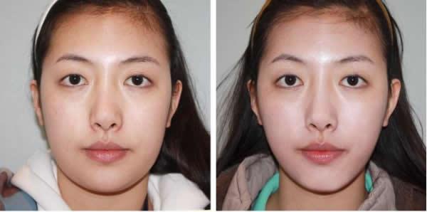 韩国赫尔希整形医院瘦脸针对比图