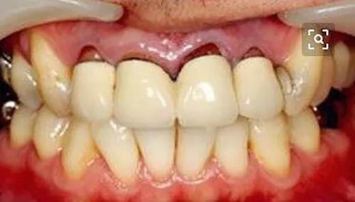 口腔科普丨烤瓷牙也有寿命十年后应该检修