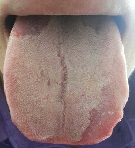 求这舌头出现这种现象是否代表有病