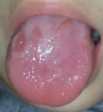 原创儿童的舌头容易出现的三种问题哪一种需要手术治疗
