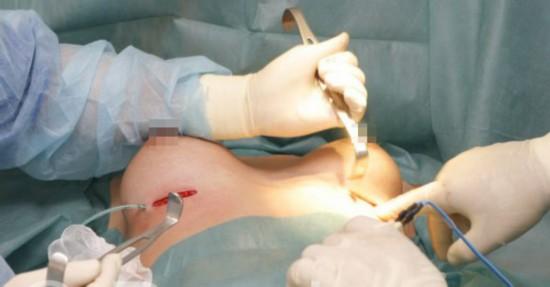 国外美女隆胸手术全过程