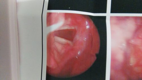 舌根组织增生咽后壁淋巴滤泡增生怎么治疗